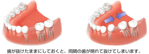 インプラント治療の目的（リスク）.jpg