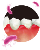 歯周病治療基本01.jpg