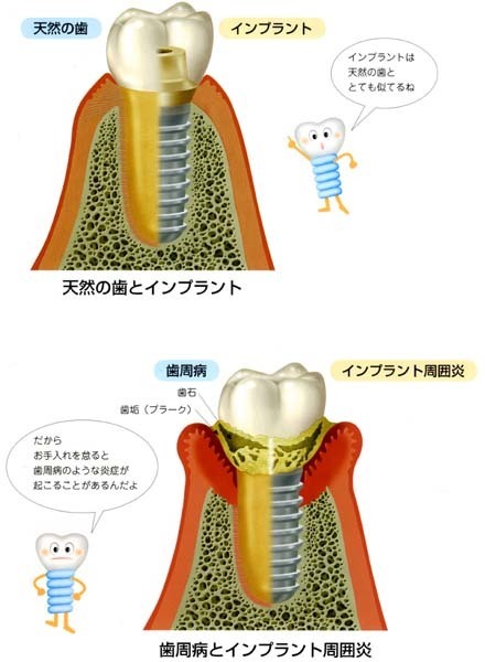 天然歯とインプラント.jpg