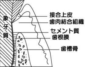 インプラント周囲炎予防図01.jpg
