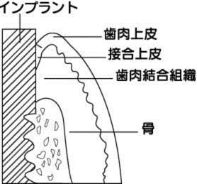 インプラント周囲炎予防図02.jpg